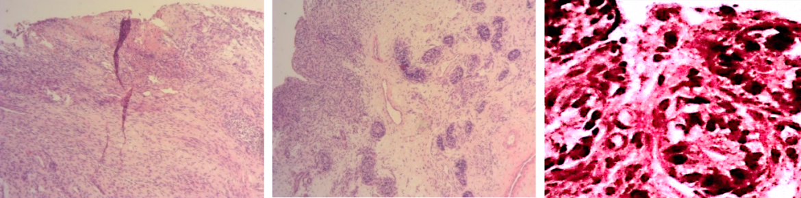 endometrit-maksinon-image1-3.png