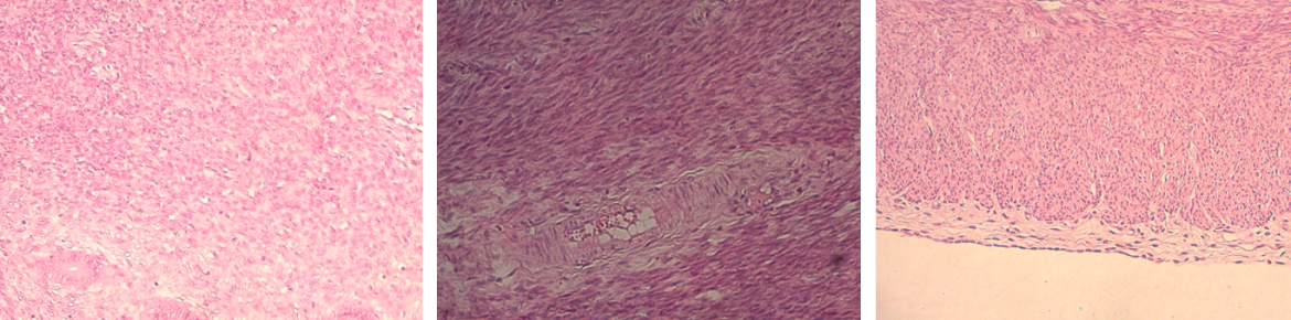 endometrit-maksinon-image4-6.png